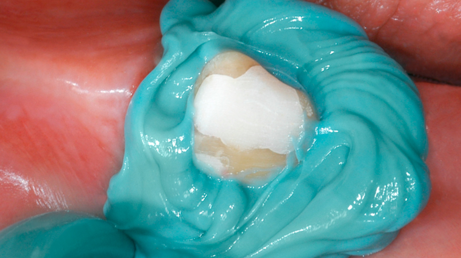 Нанесение Хонигум Моно - этап 1